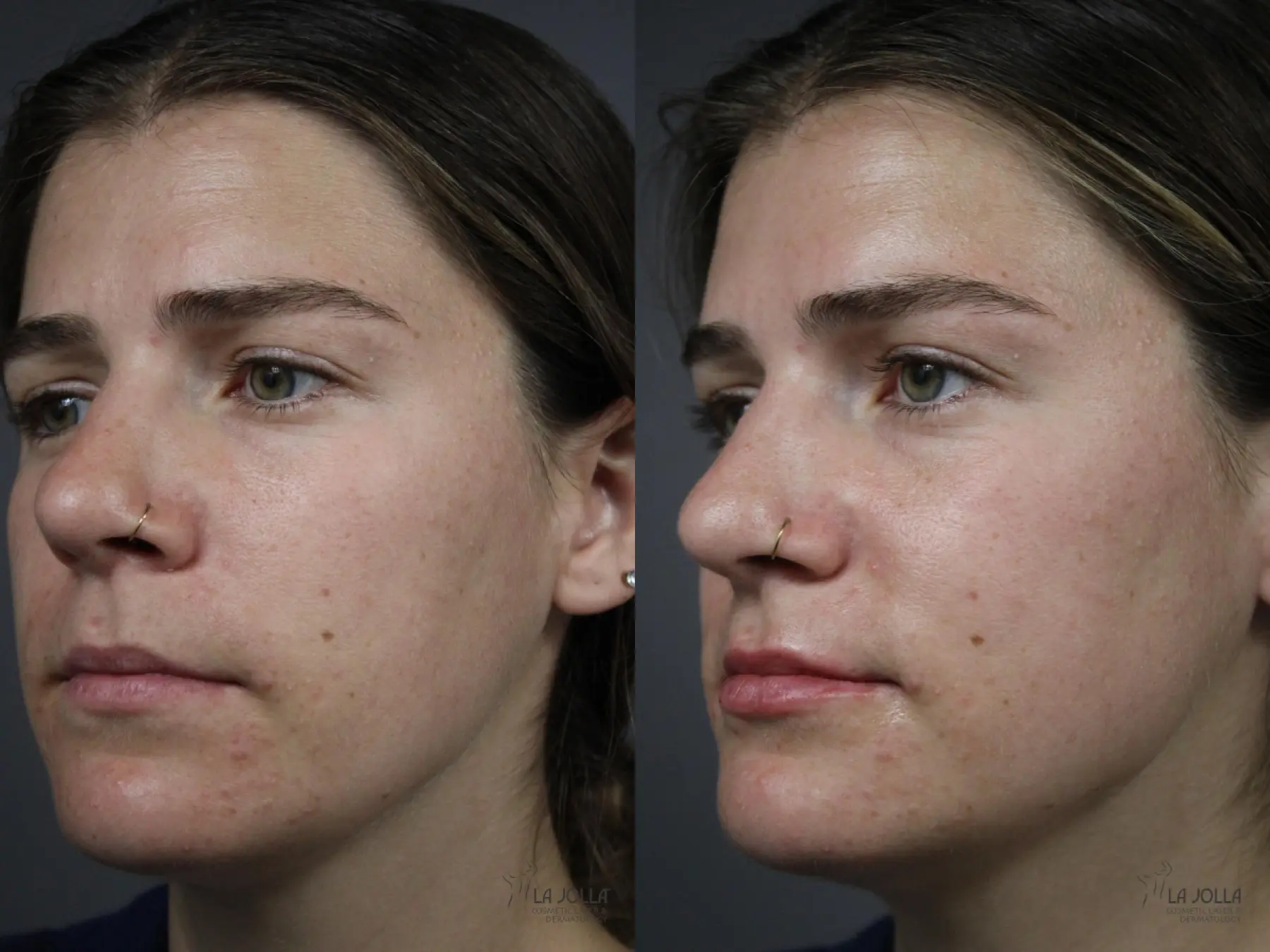 Lip Filler: Patient 3 - Before and After 3