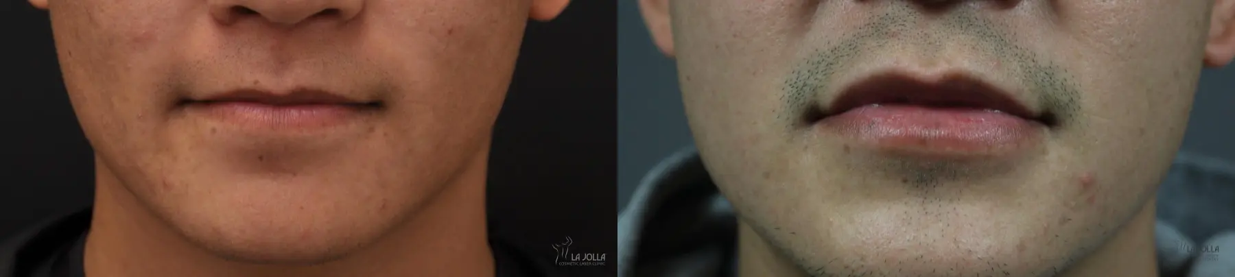 Lip Filler: Patient 12 - Before and After 1
