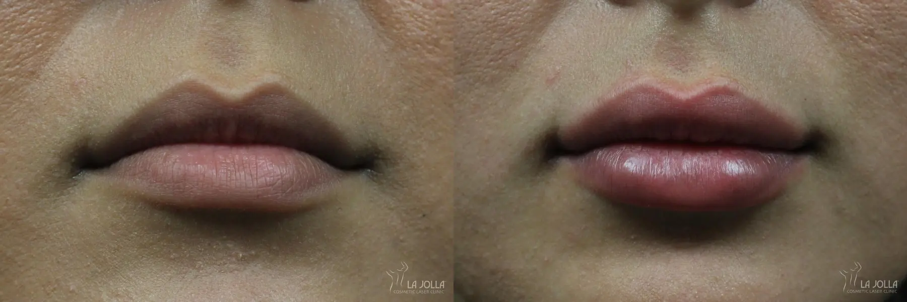 Lip Filler: Patient 1 - Before and After 2