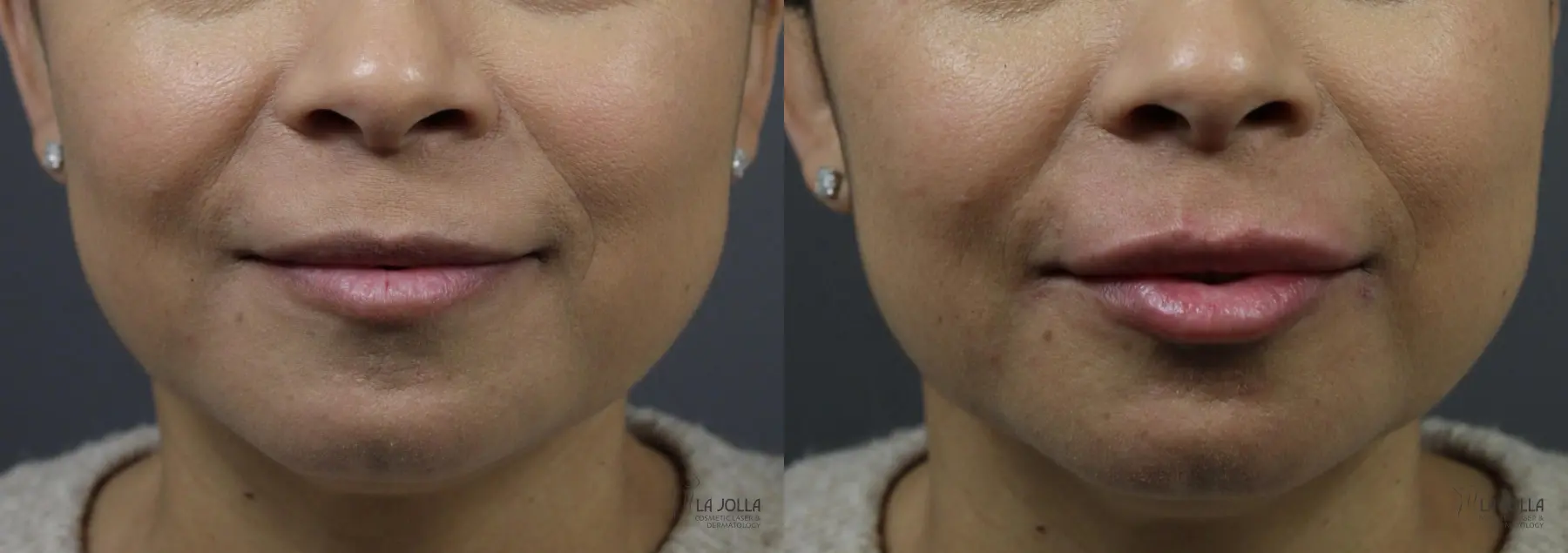 Lip Filler: Patient 1 - Before and After  