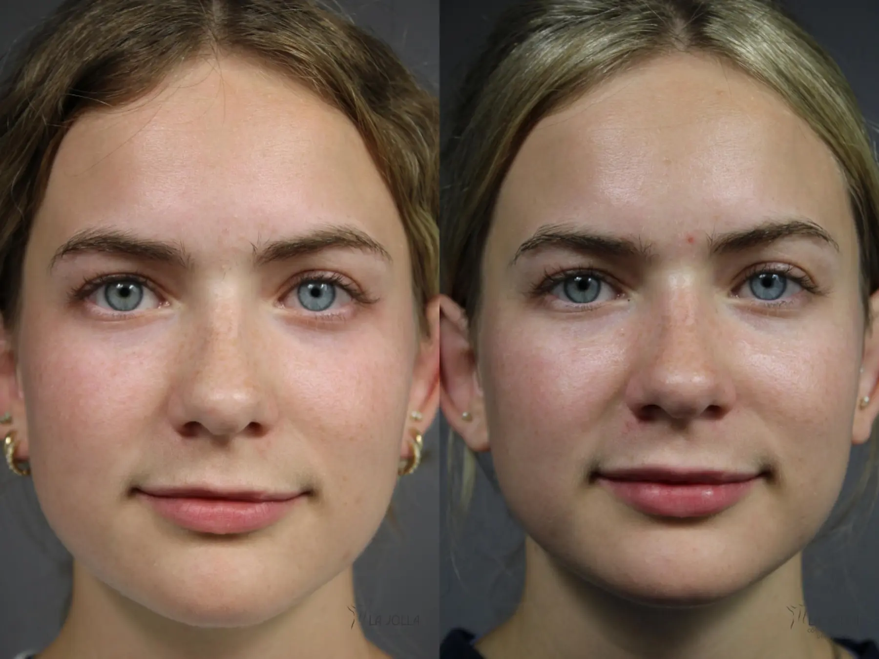 Lip Filler: Patient 1 - Before and After  