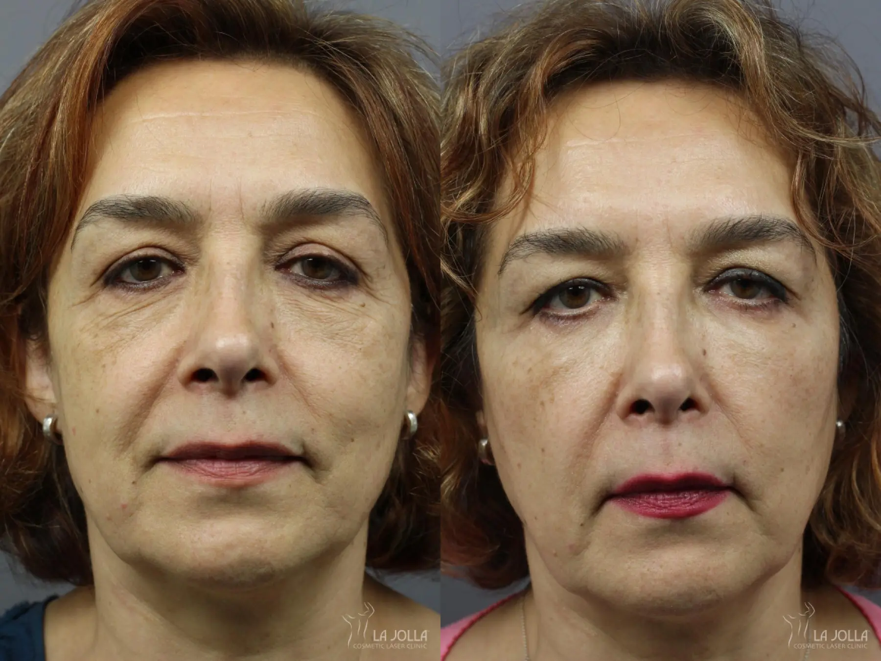 Lip Filler: Patient 15 - Before and After 1