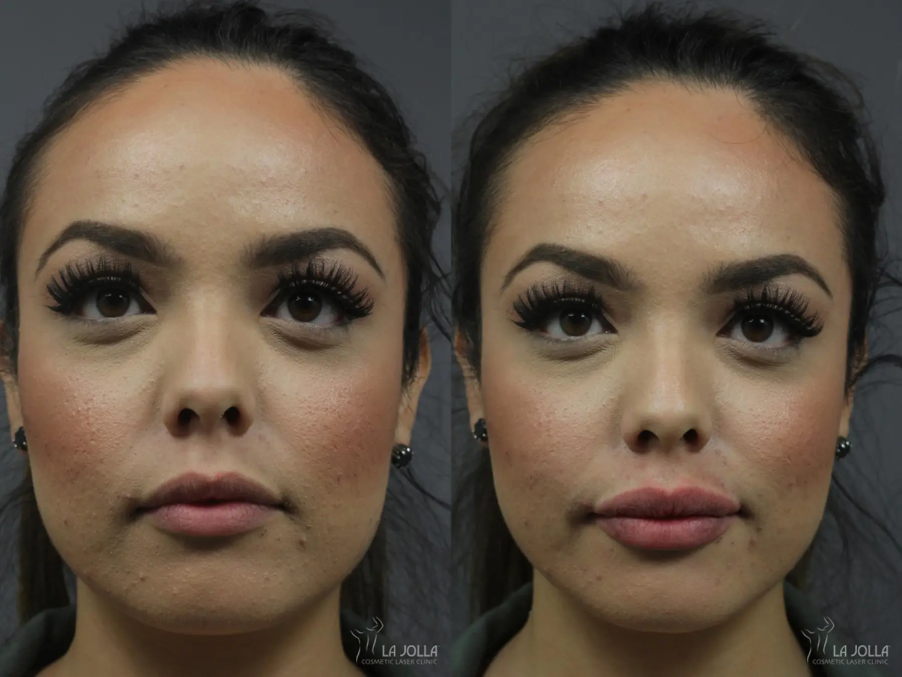 Lip Filler: Patient 4 - Before and After 1