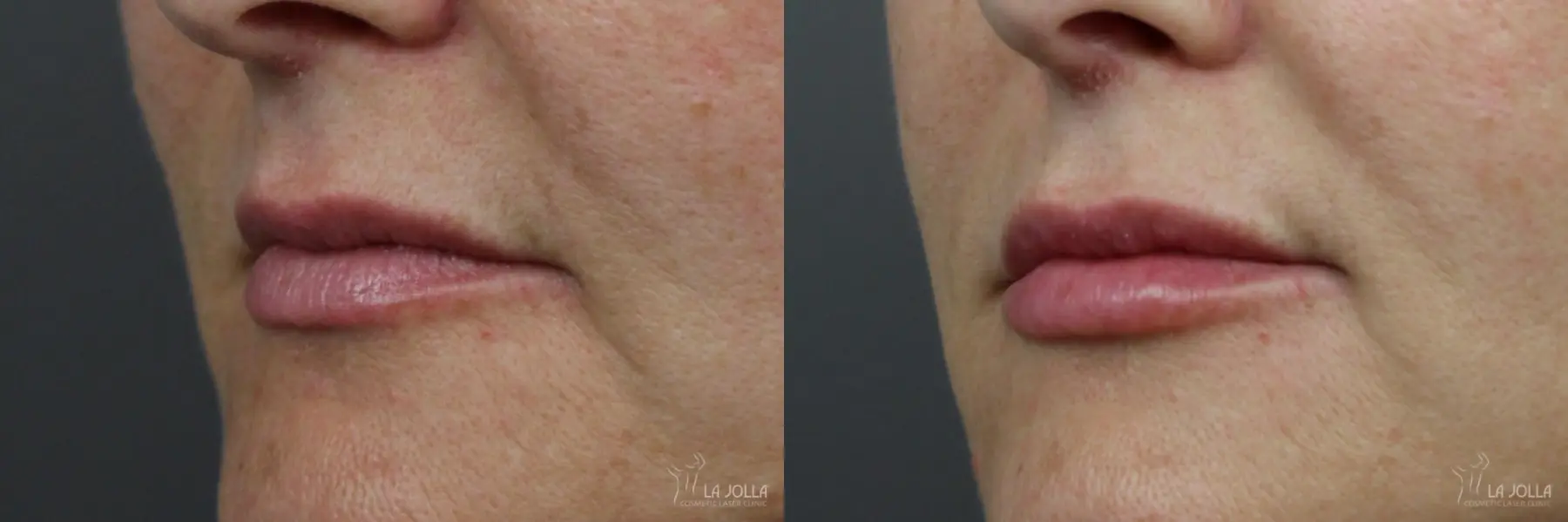 Lip Filler: Patient 3 - Before and After 1