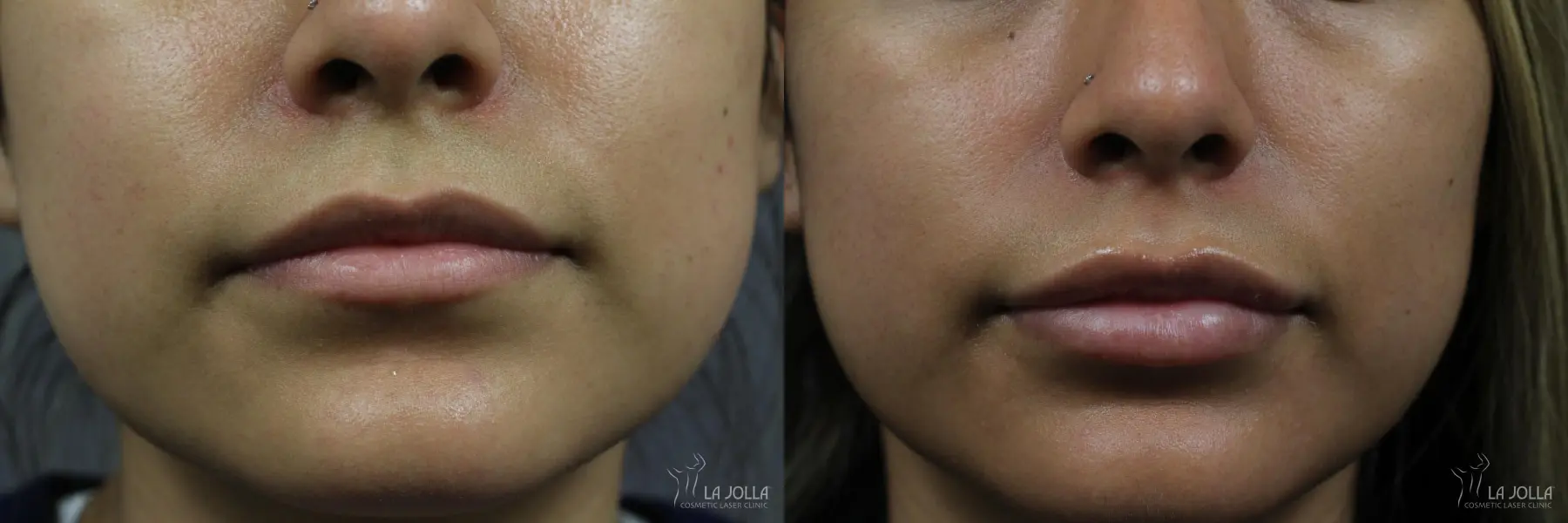 Lip Filler: Patient 12 - Before and After 1