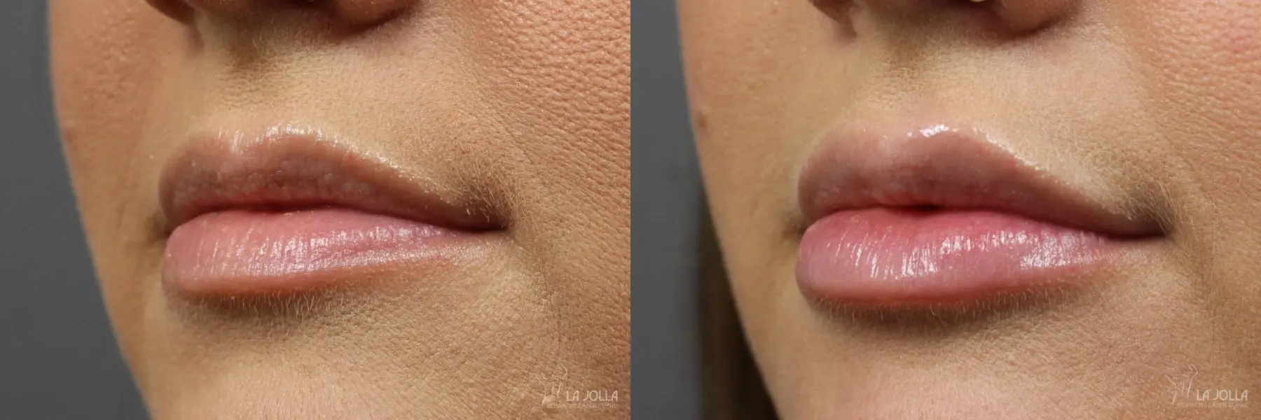Lip Filler: Patient 2 - Before and After  