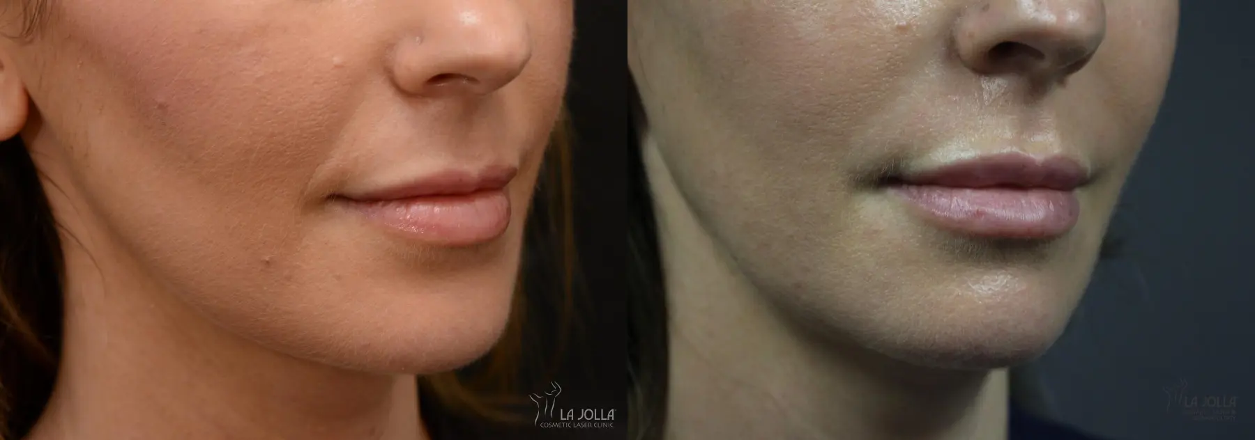 Lip Filler: Patient 13 - Before and After 1
