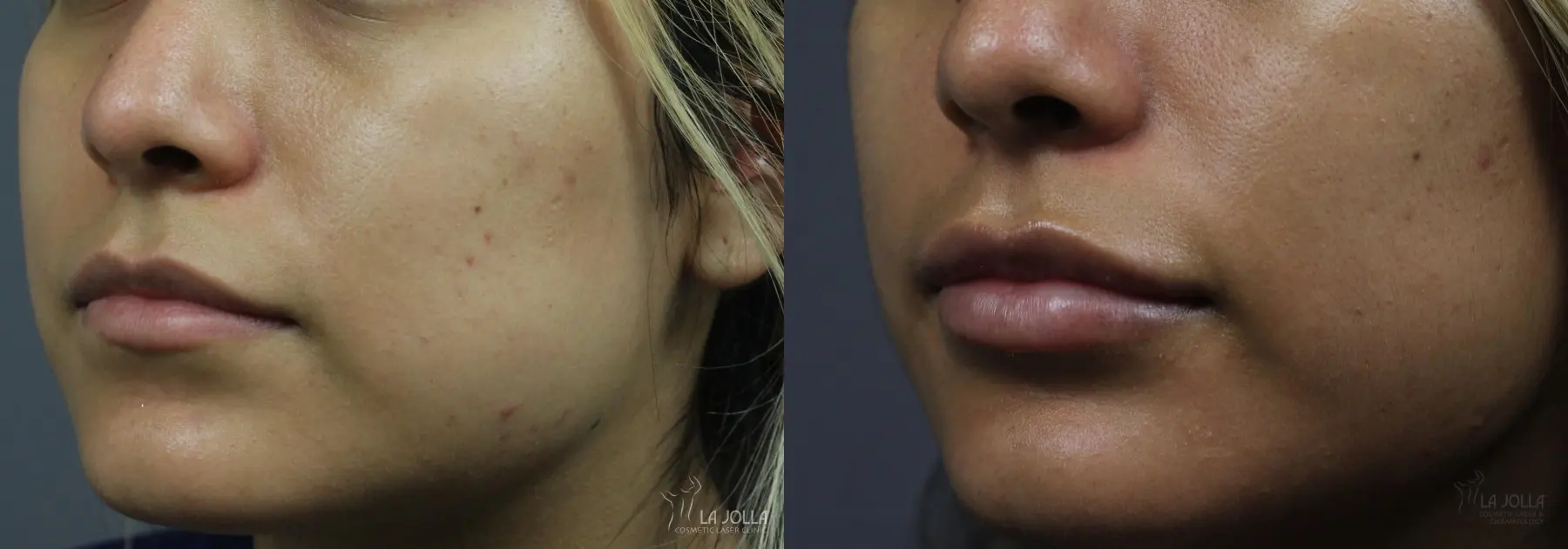 Lip Filler: Patient 14 - Before and After 3