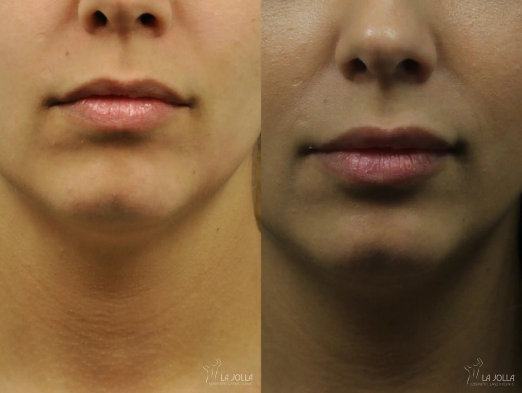 Lip Filler: Patient 9 - Before and After 1