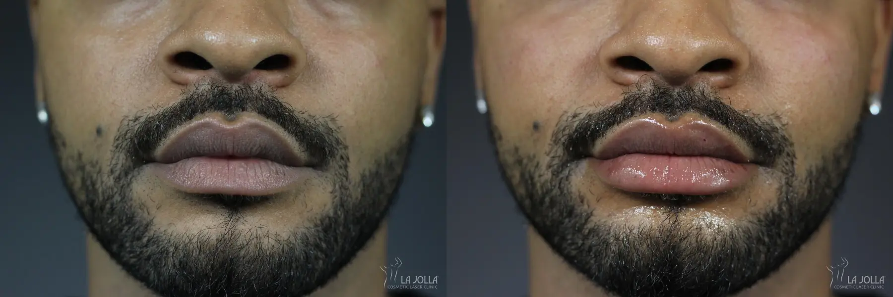 Lip Filler: Patient 18 - Before and After 1