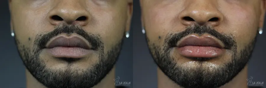 Lip Filler: Patient 3 - Before and After  