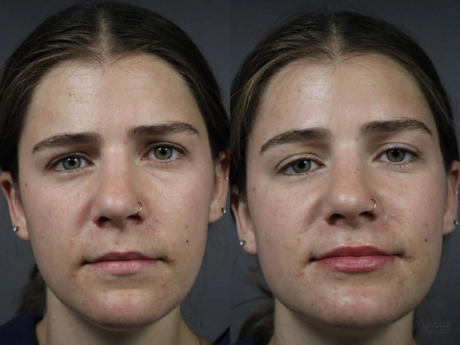 Lip Filler: Patient 2 - Before and After  