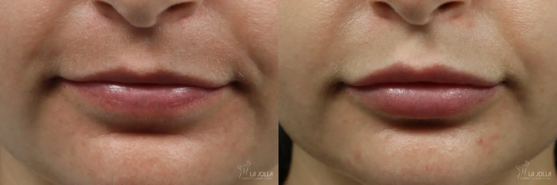 Lip Filler: Patient 7 - Before and After 1