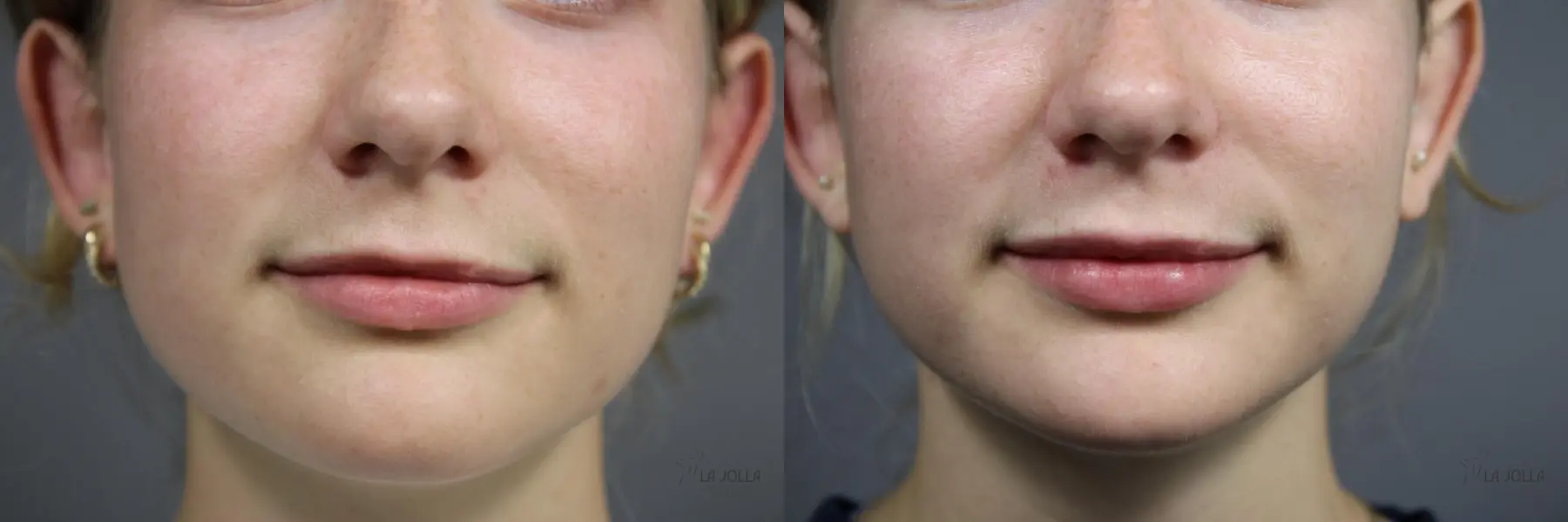 Lip Filler: Patient 1 - Before and After 2