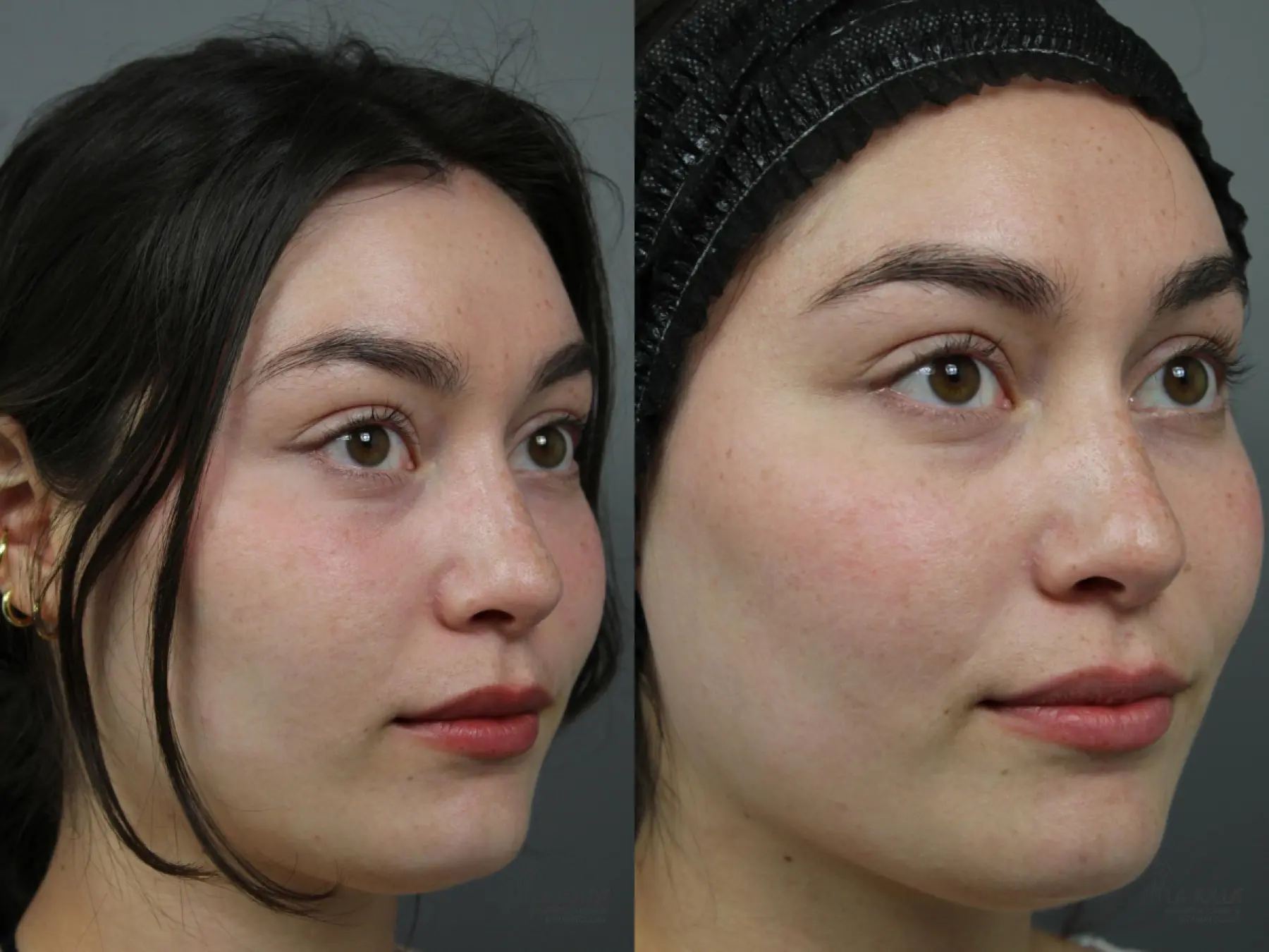 Liquid Facelift