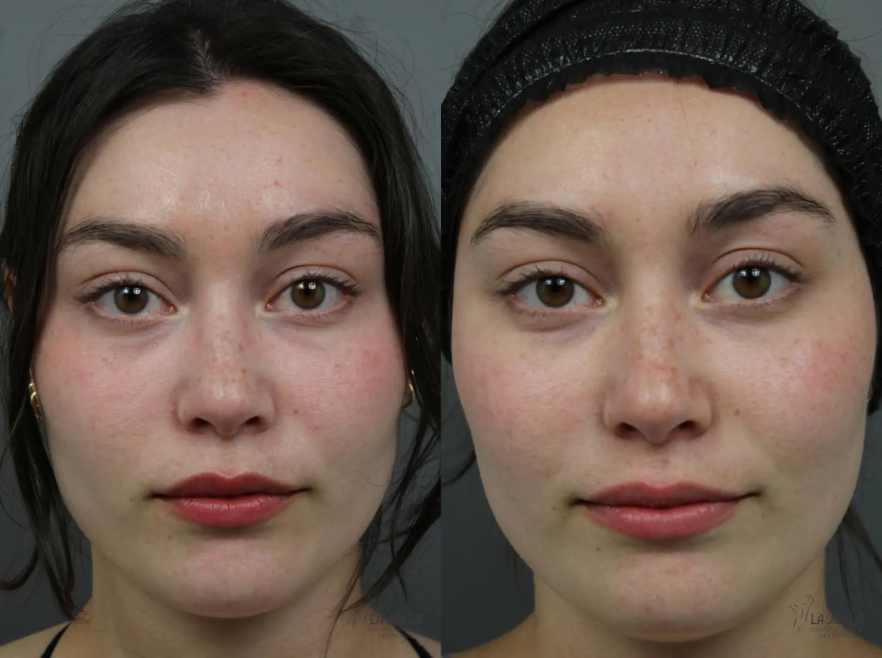Liquid Facelift