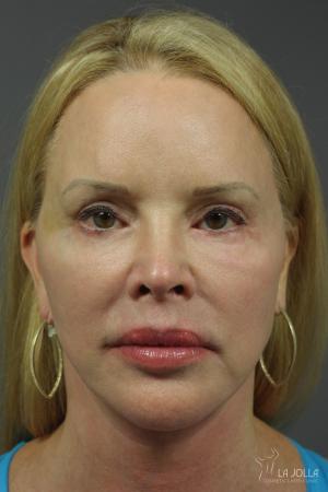 Liquid Facelift: Patient 4 - After  