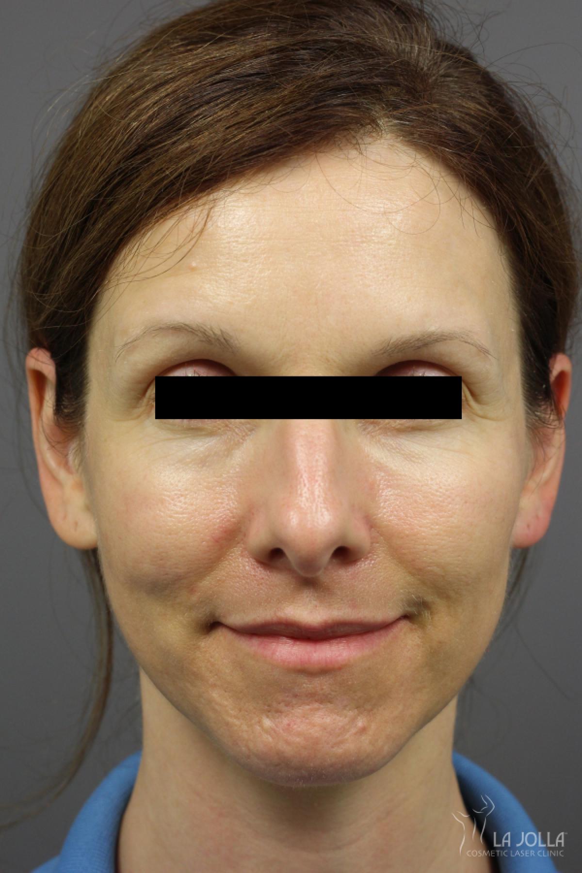 Acne Rejuvenation: Patient 3 - After 1