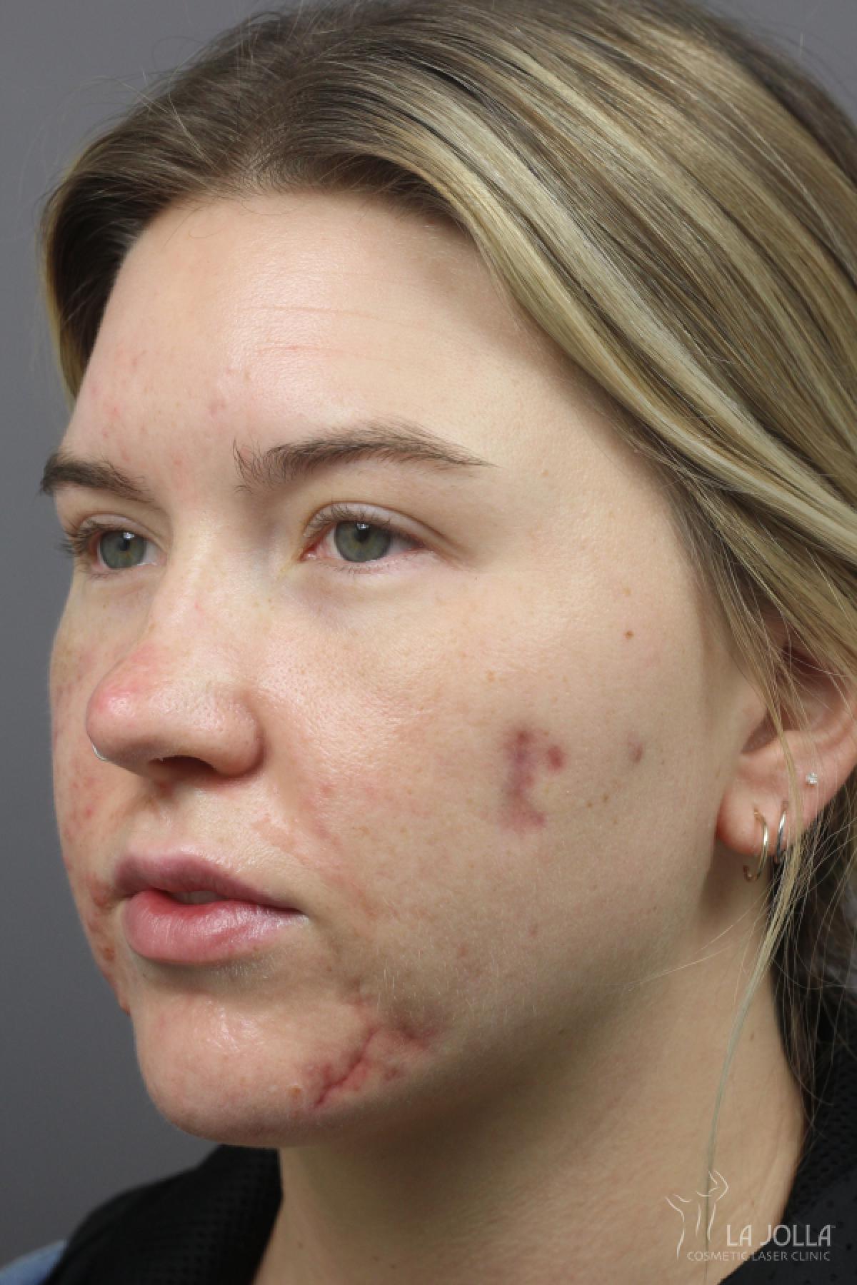 Acne Rejuvenation: Patient 4 - Before and After 2
