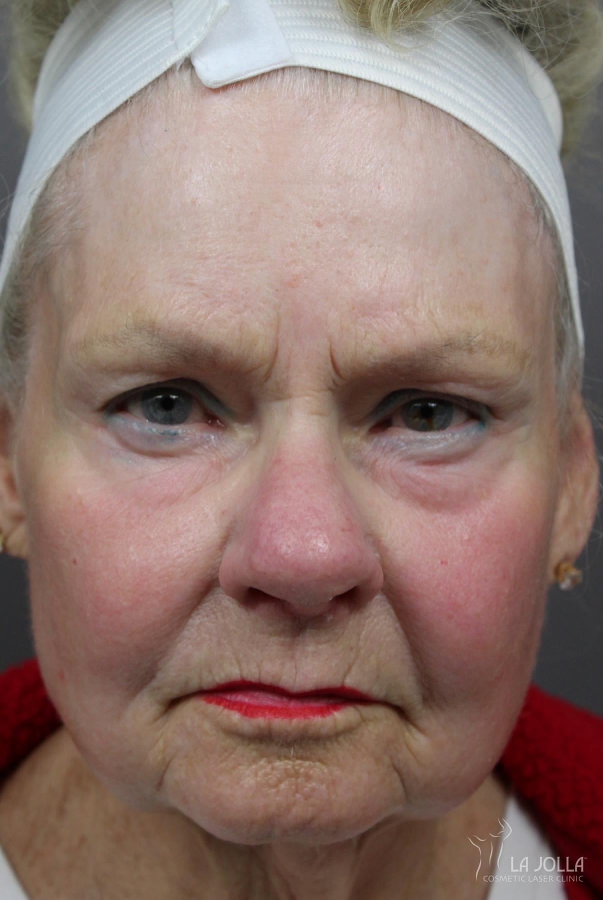 CO2 Laser: Patient 12 - After 3