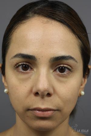 Sculptra®: Patient 9 - Before 