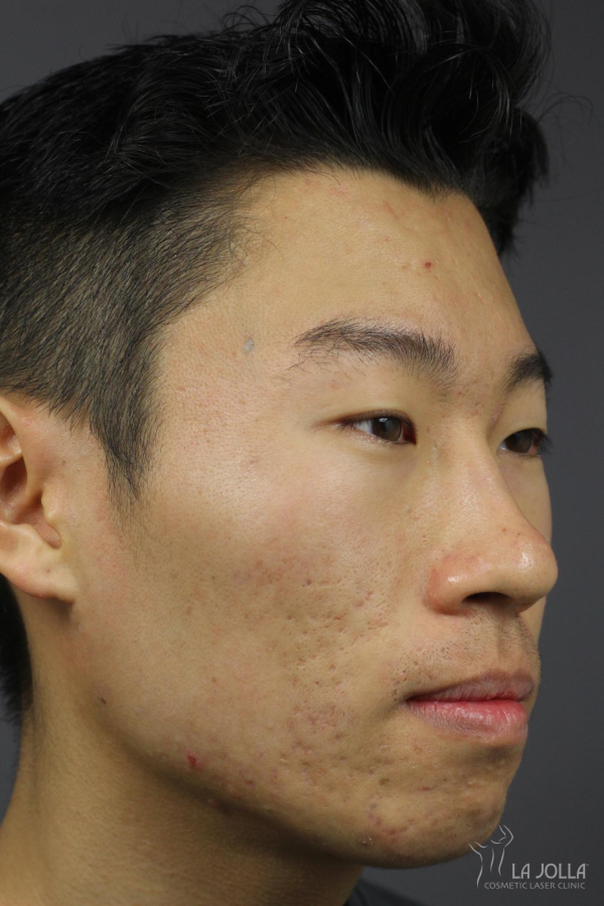 StarWalker® Laser: Patient 4 - After  