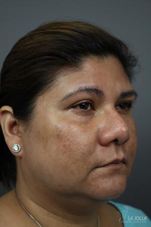 Chemical Peel: Patient 5 - Before and After 2