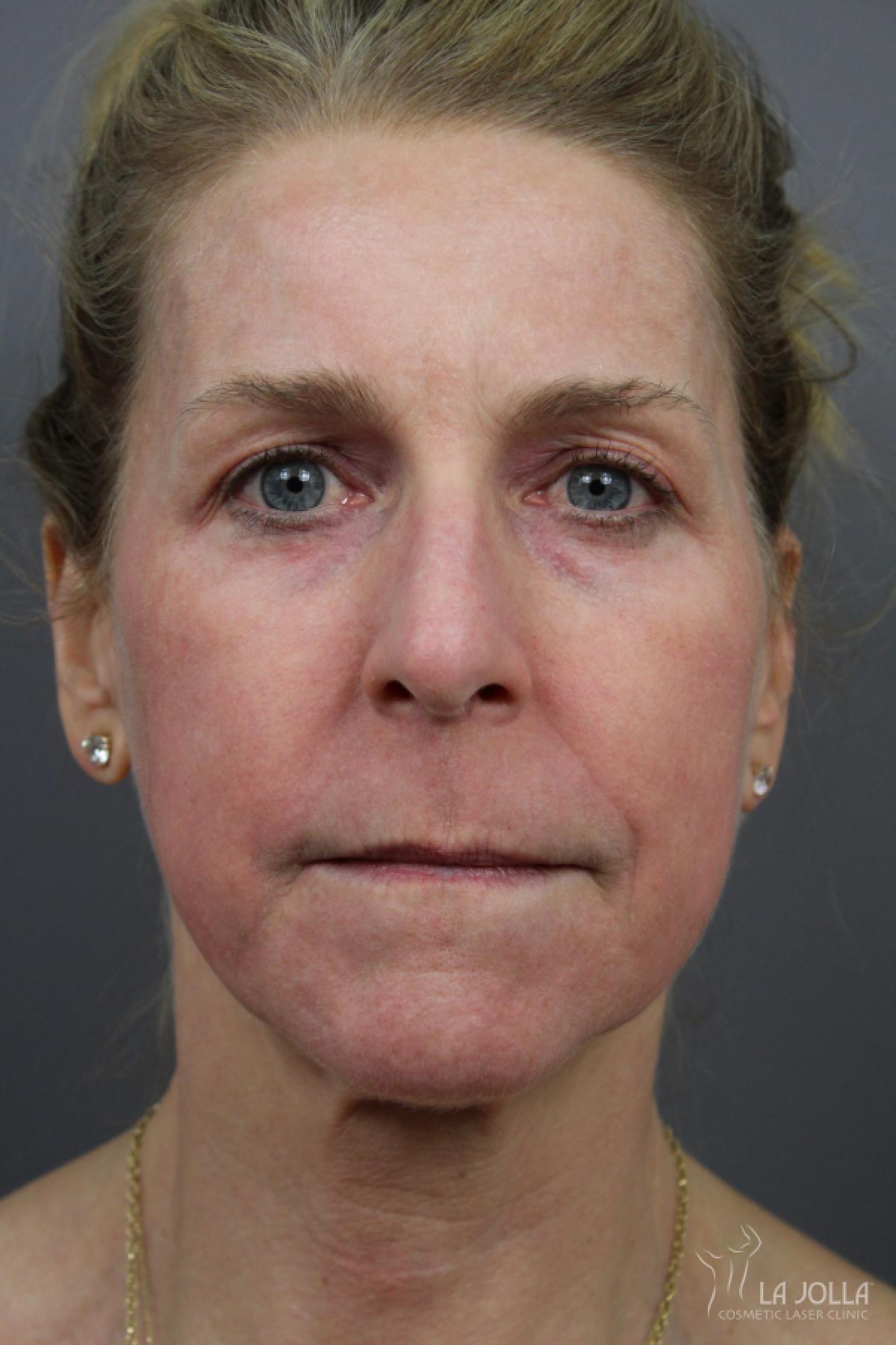 CO2 Laser: Patient 16 - After 1