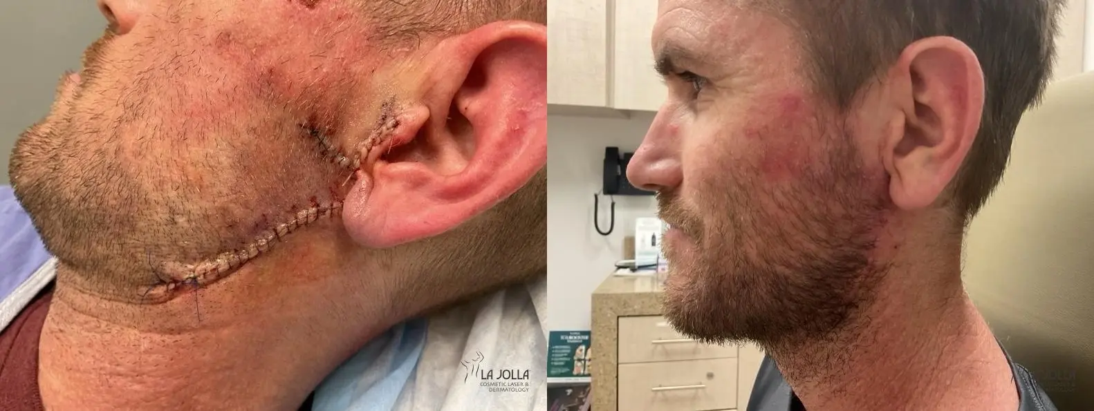 Mohs Surgery: Patient 3 - Before and After 2