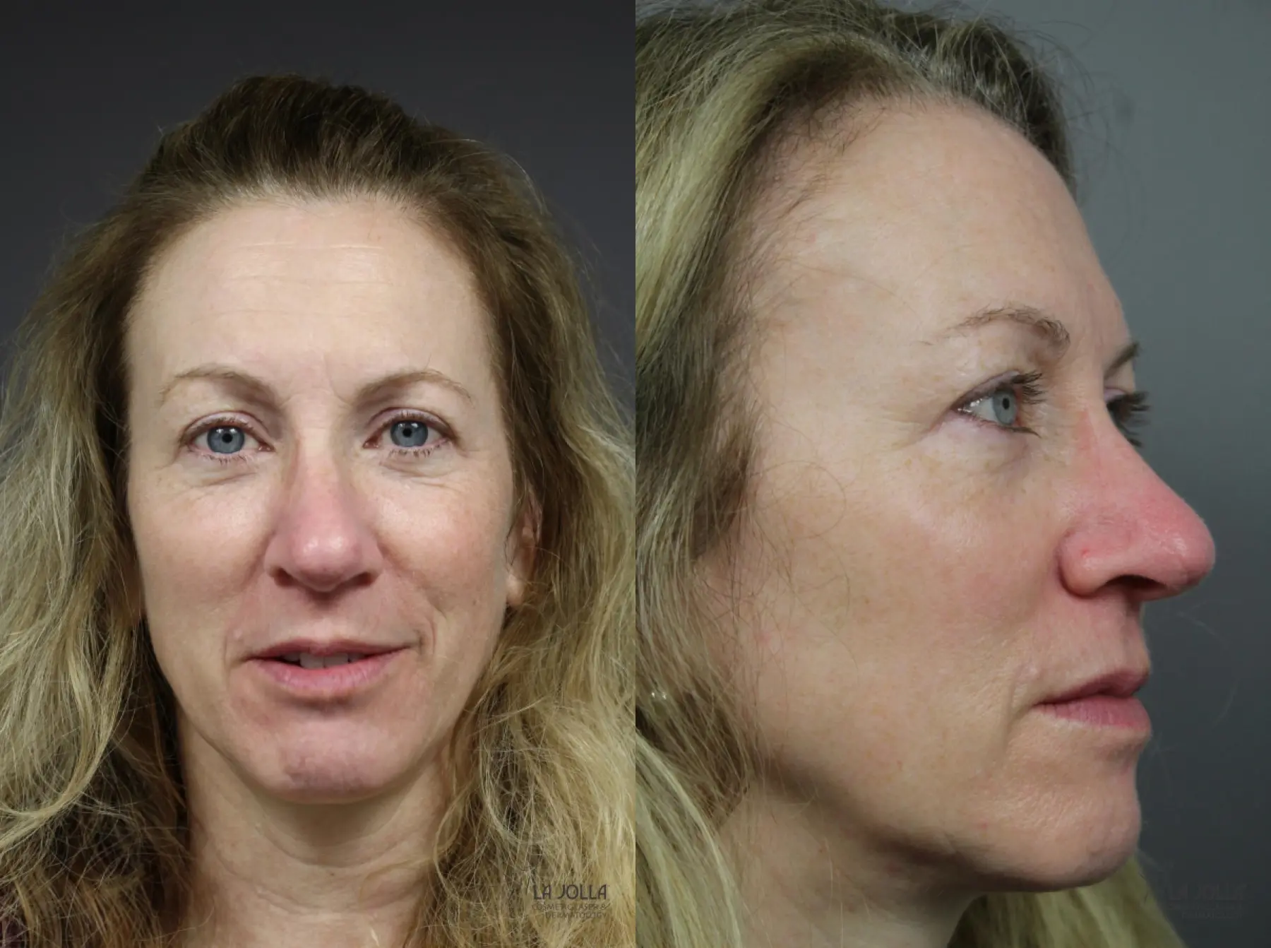 Mohs Surgery: Patient 1 - Before and After 3