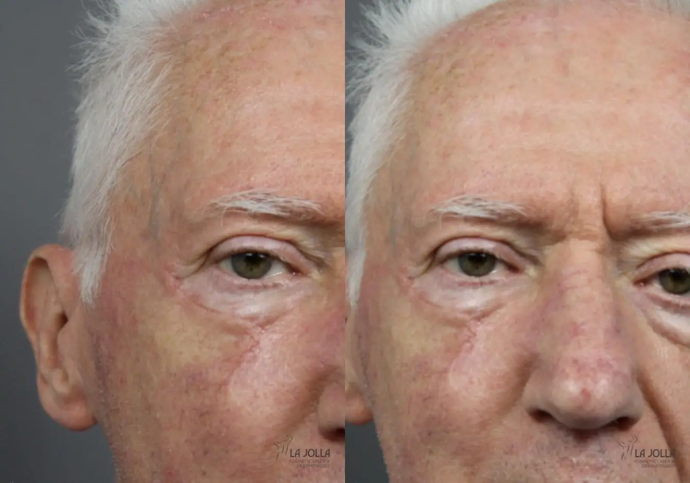 Mohs Surgery: Patient 2 - Before and After 3
