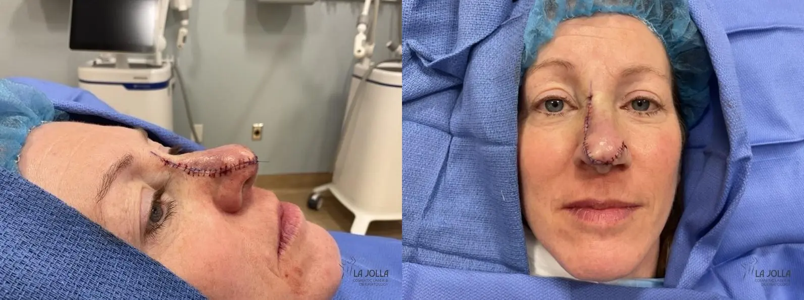 Mohs Surgery: Patient 1 - Before and After 2