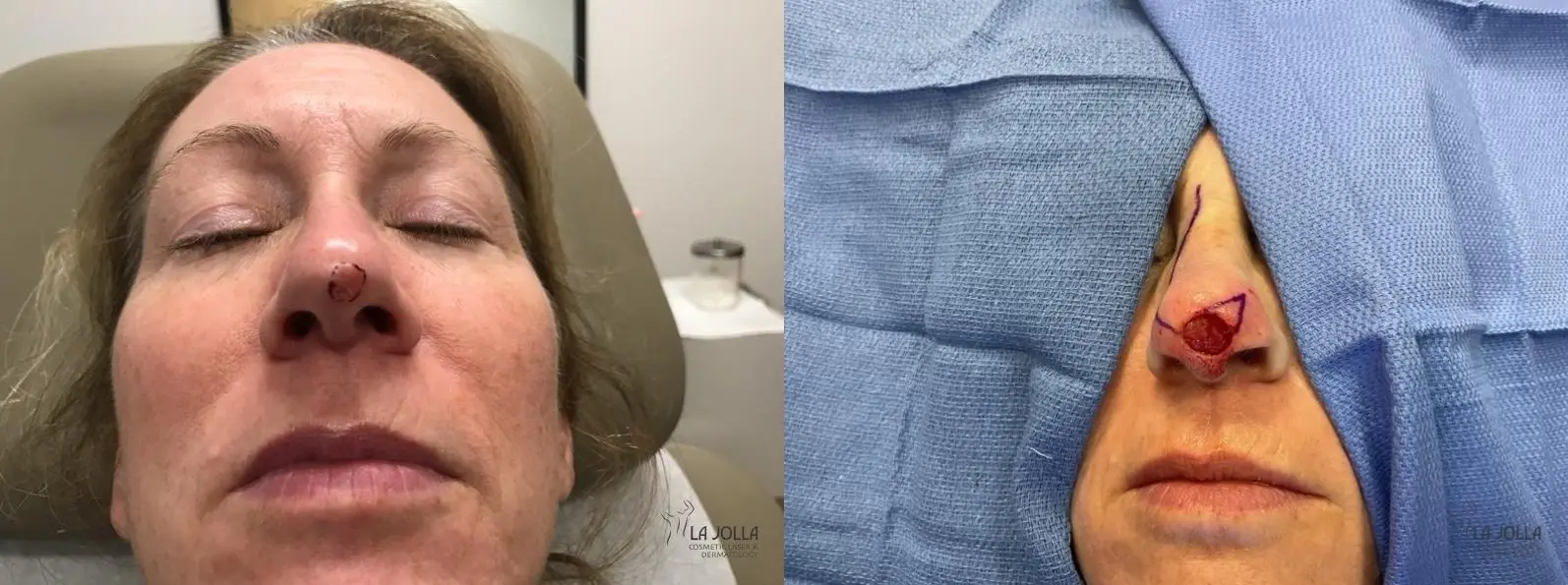 Mohs Surgery: Patient 1 - Before and After  