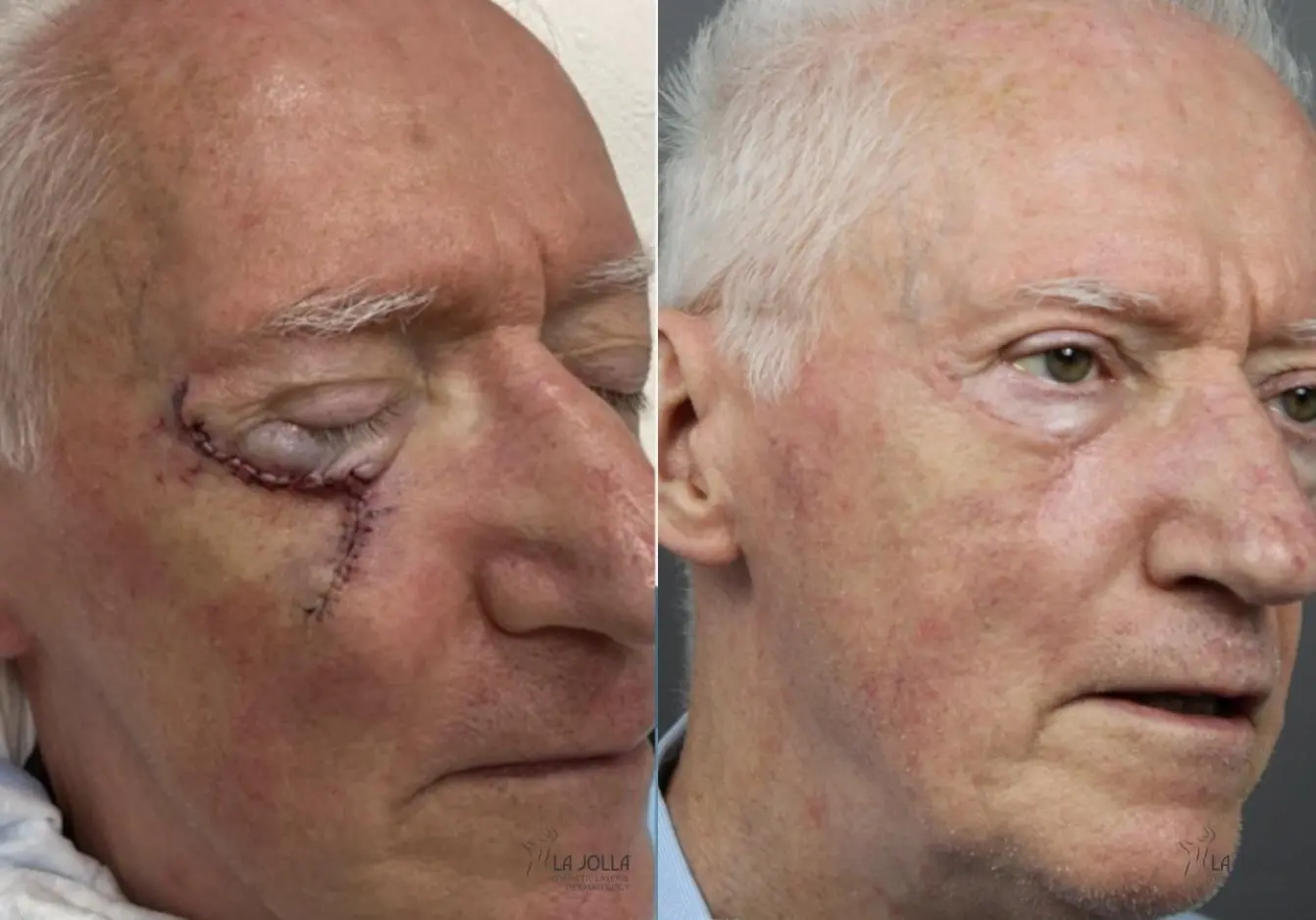 Mohs Surgery: Patient 2 - Before and After 2