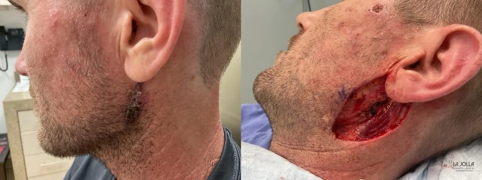 Mohs Surgery: Patient 3 - Before and After  