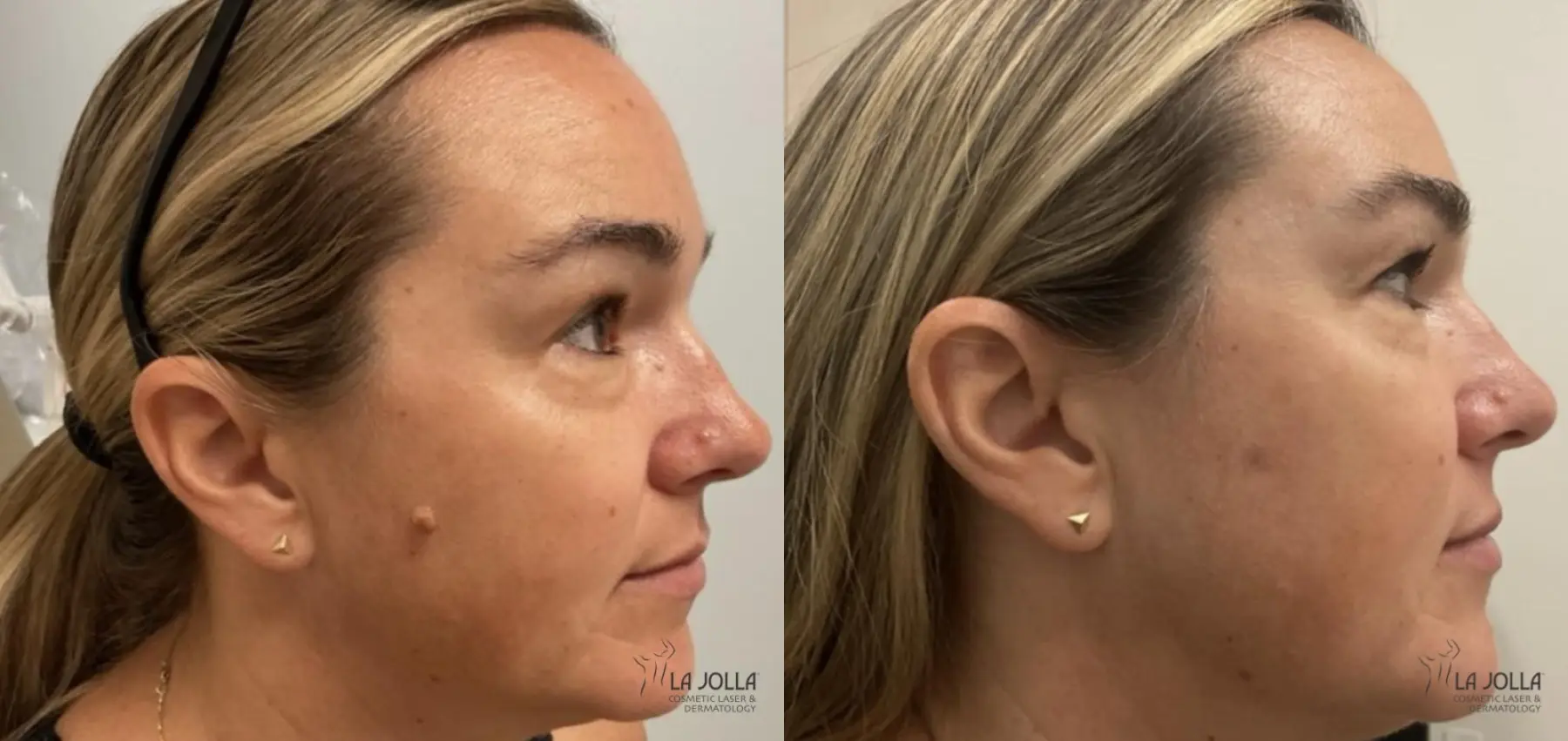 Mole Removal: Patient 1 - Before and After