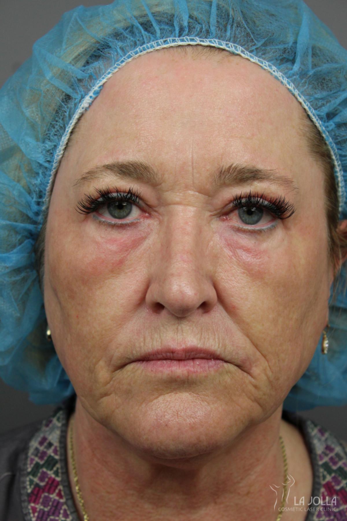 CO2 Laser: Patient 22 - After 1