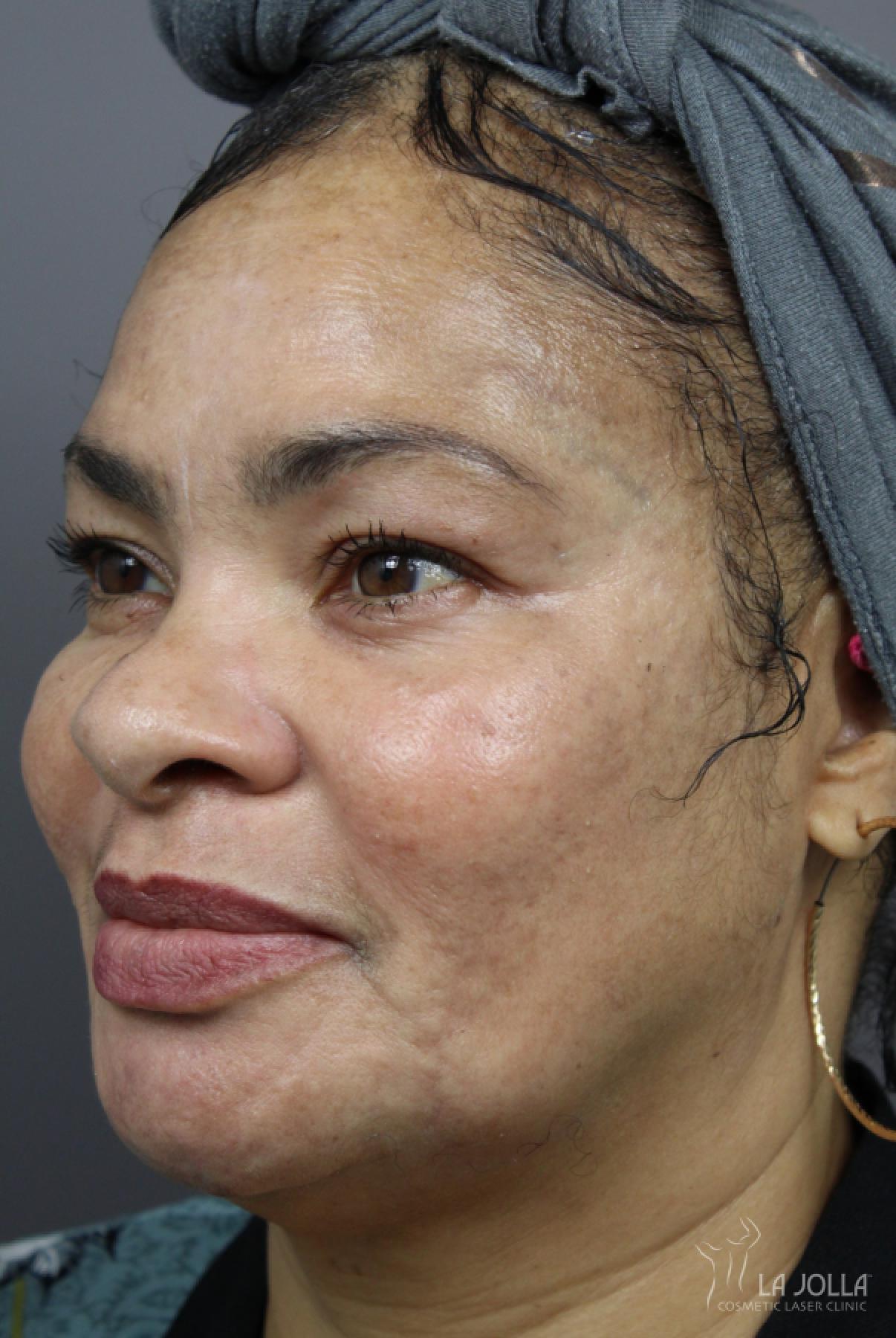 Chemical Peel: Patient 4 - After 1