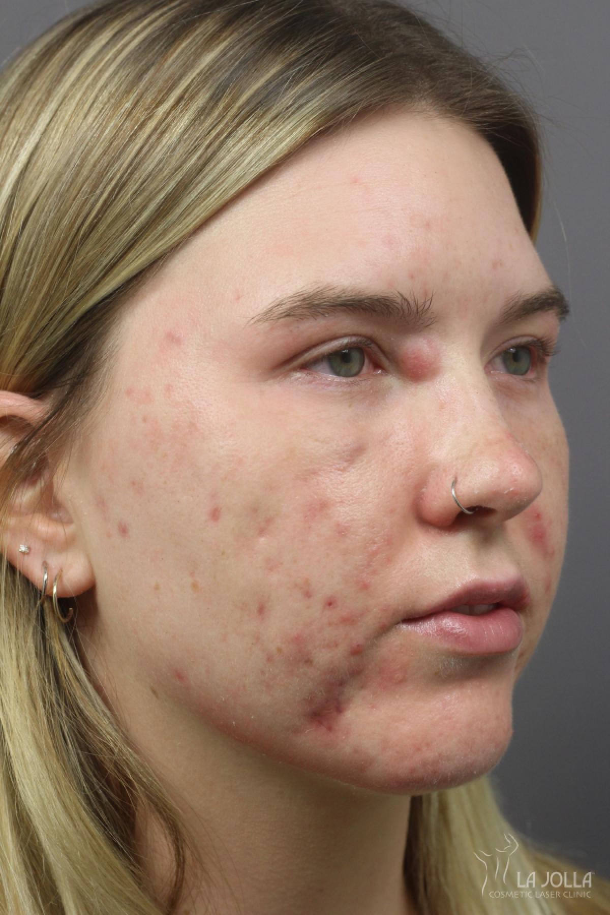 Acne Rejuvenation: Patient 4 - Before 1