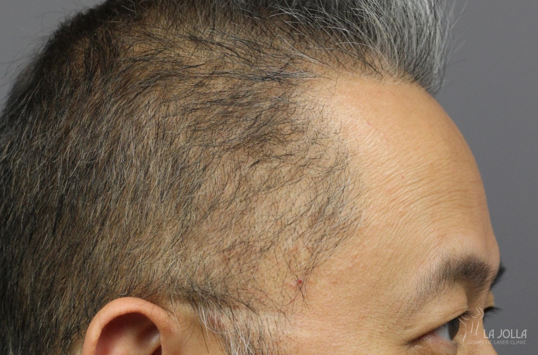 Hair Restoration: Patient 2 - After 3