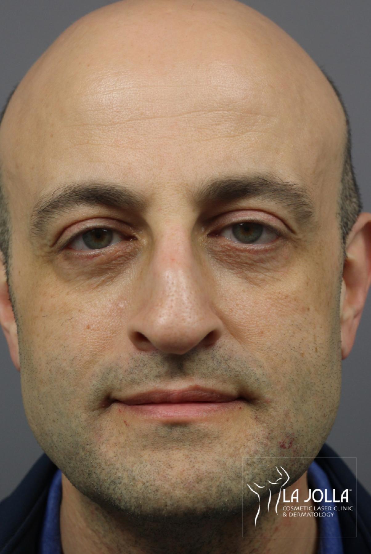 Sculptra Before After Gallery