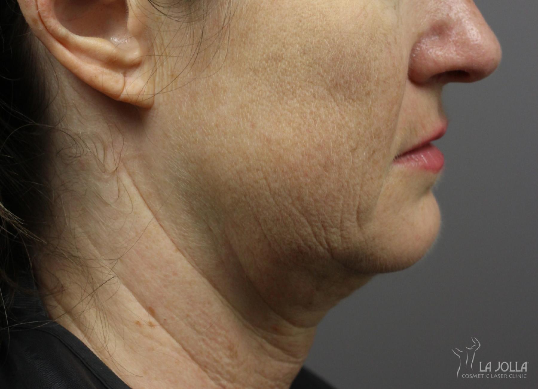 Kybella: Patient 7 - Before 