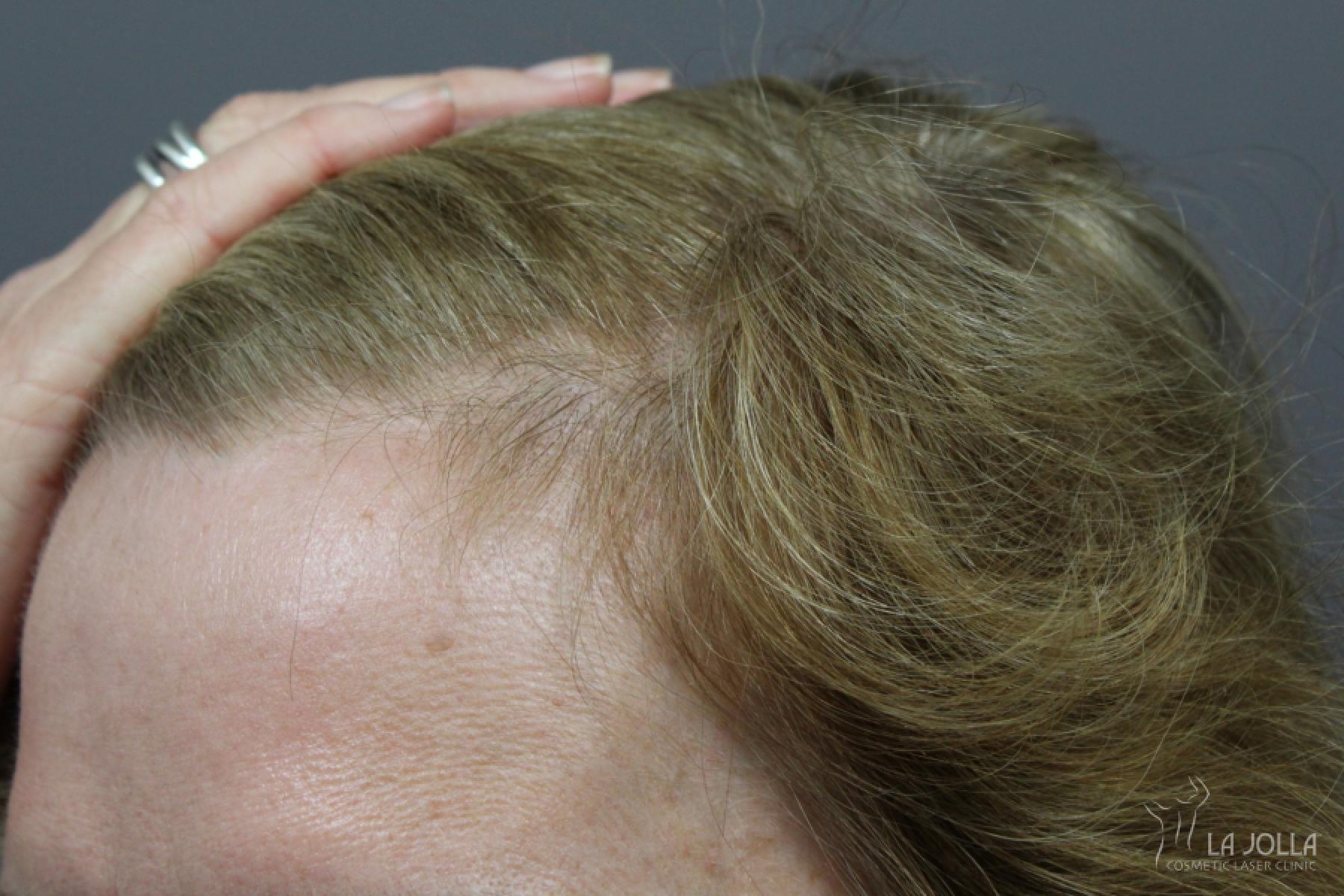 Hair Restoration: Patient 2 - After 1