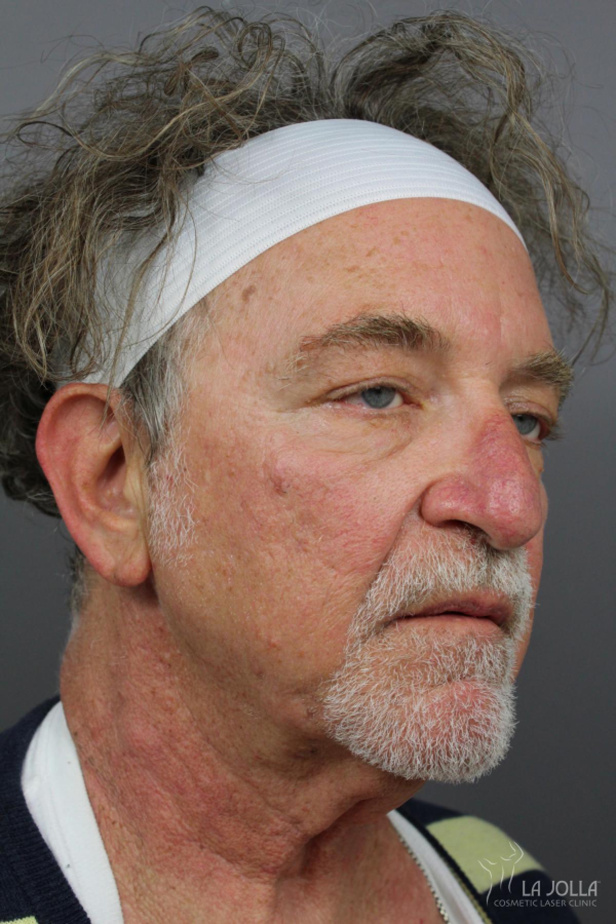 Poke A Dot Lift Patient 1 After Procedure