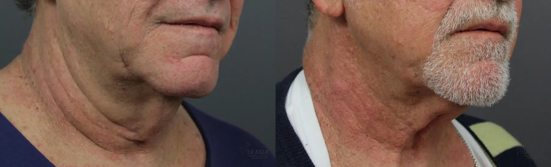 Non Surgical Neck Lift: Patient 6 - Before and After  