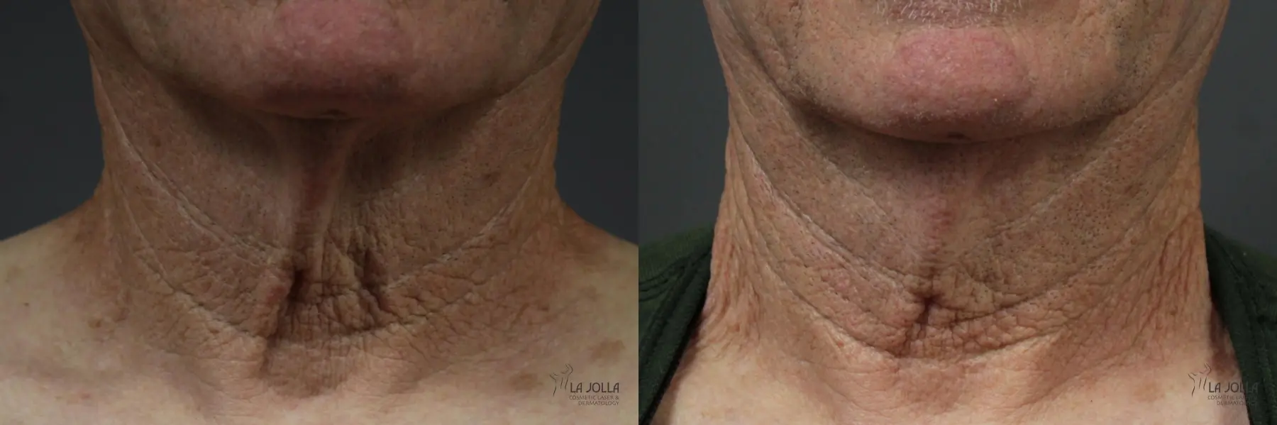 Non Surgical Neck Lift: Patient 2 - Before and After  