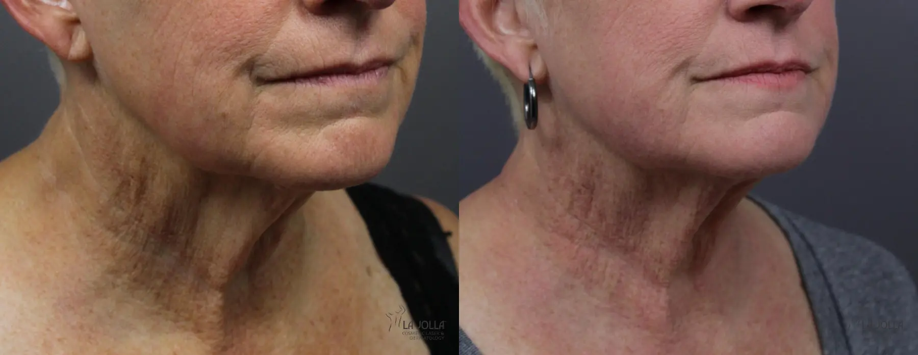 Non Surgical Neck Lift: Patient 5 - Before and After  
