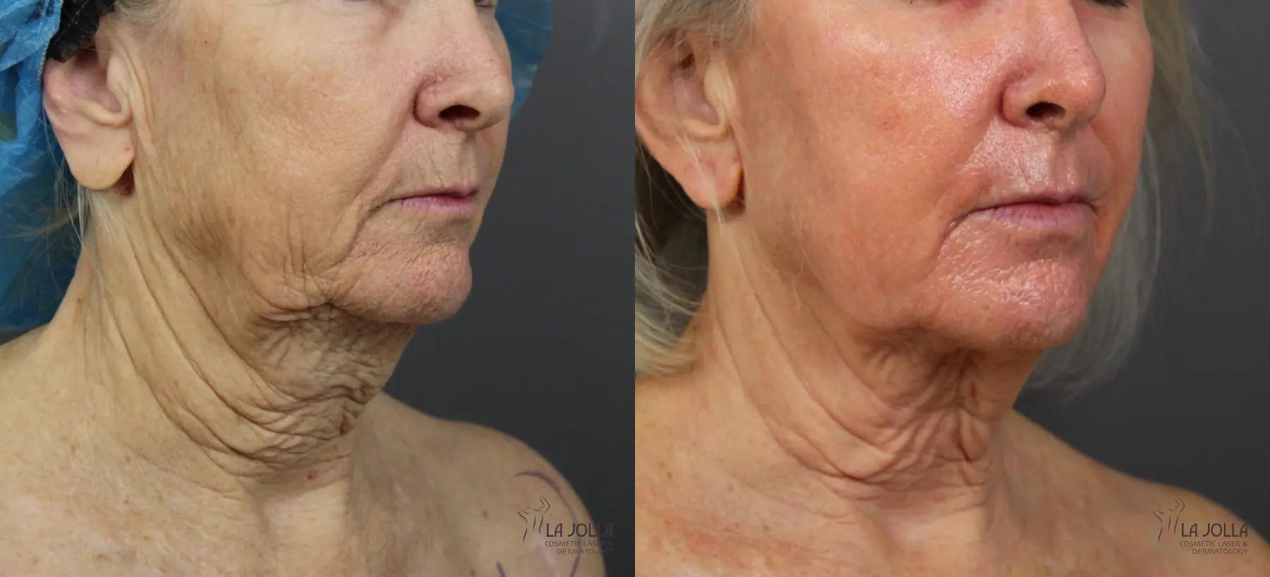 Non Surgical Neck Lift: Patient 3 - Before and After 3