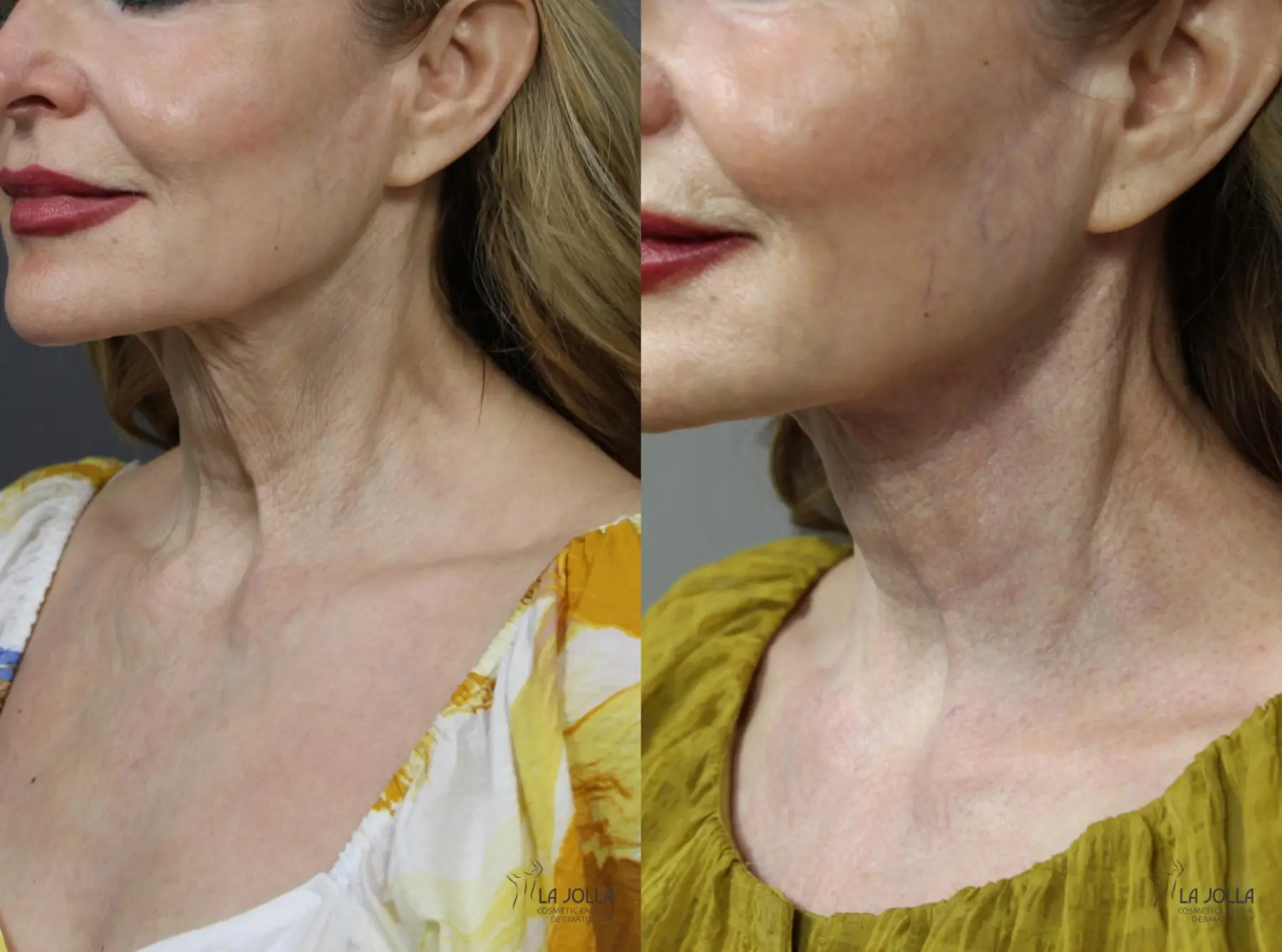 Non Surgical Neck Lift: Patient 1 - Before and After 3