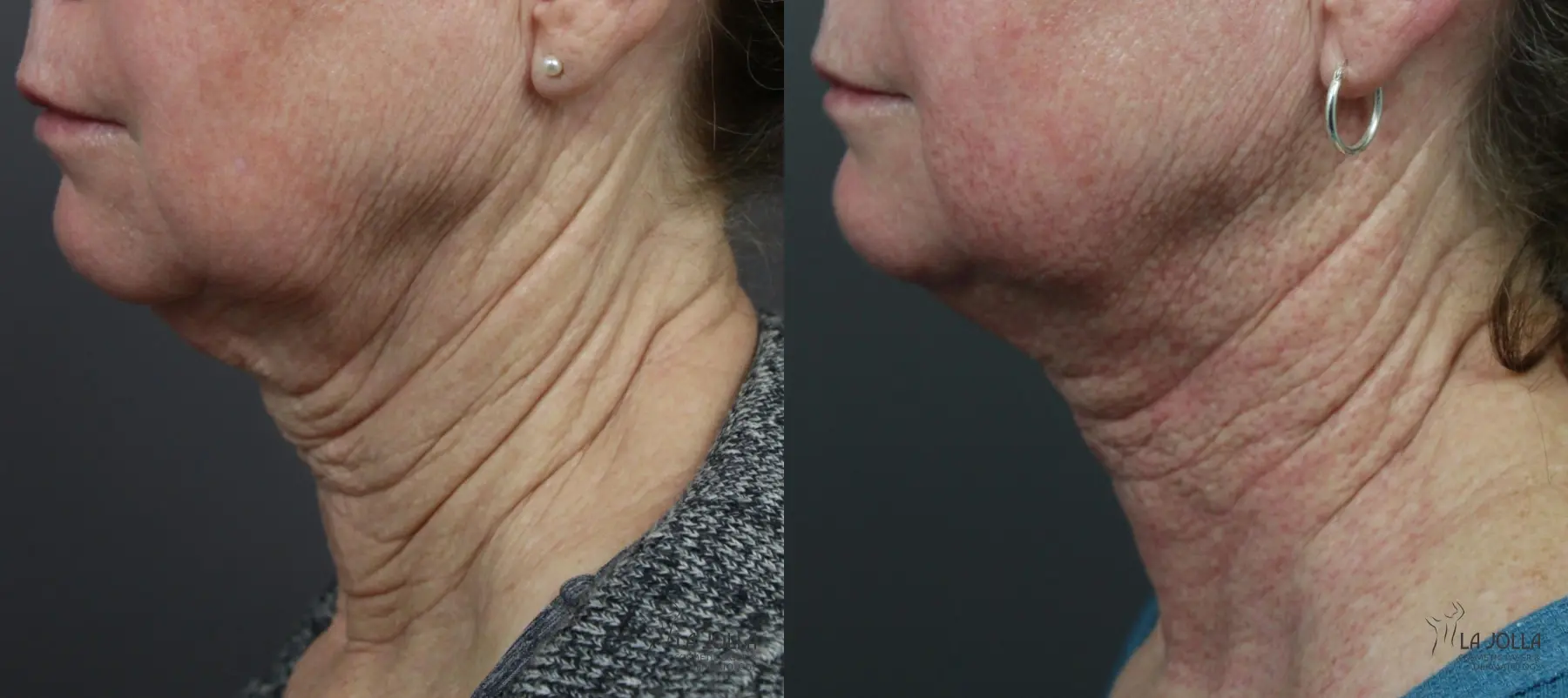 Non Surgical Neck Lift: Patient 4 - Before and After  